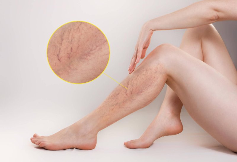 Venous mesh on the legs