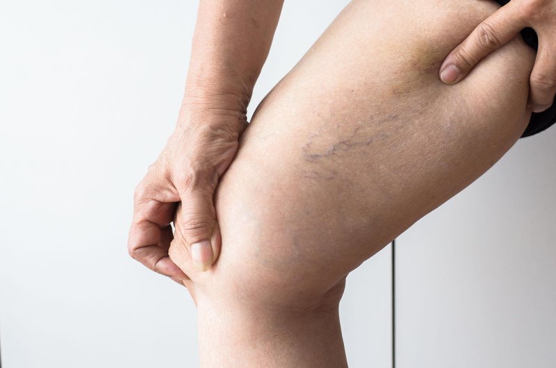 Varicose veins