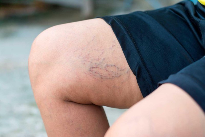 Reticular varicose veins