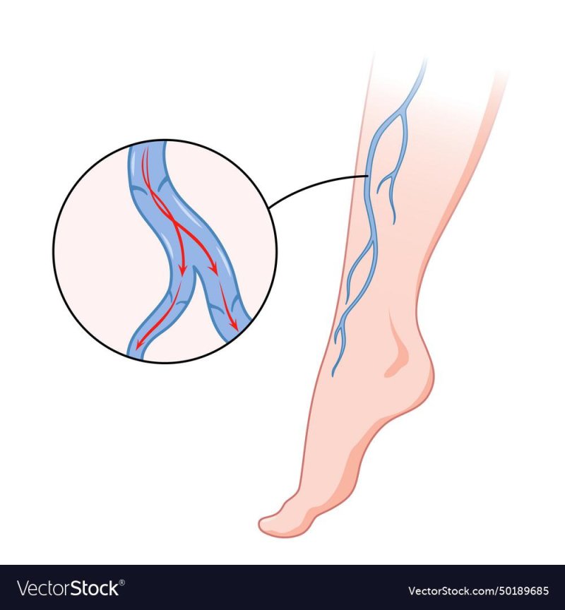 Varicose veins