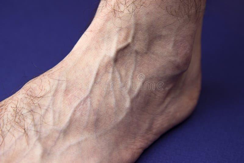 Venous mesh on the feet