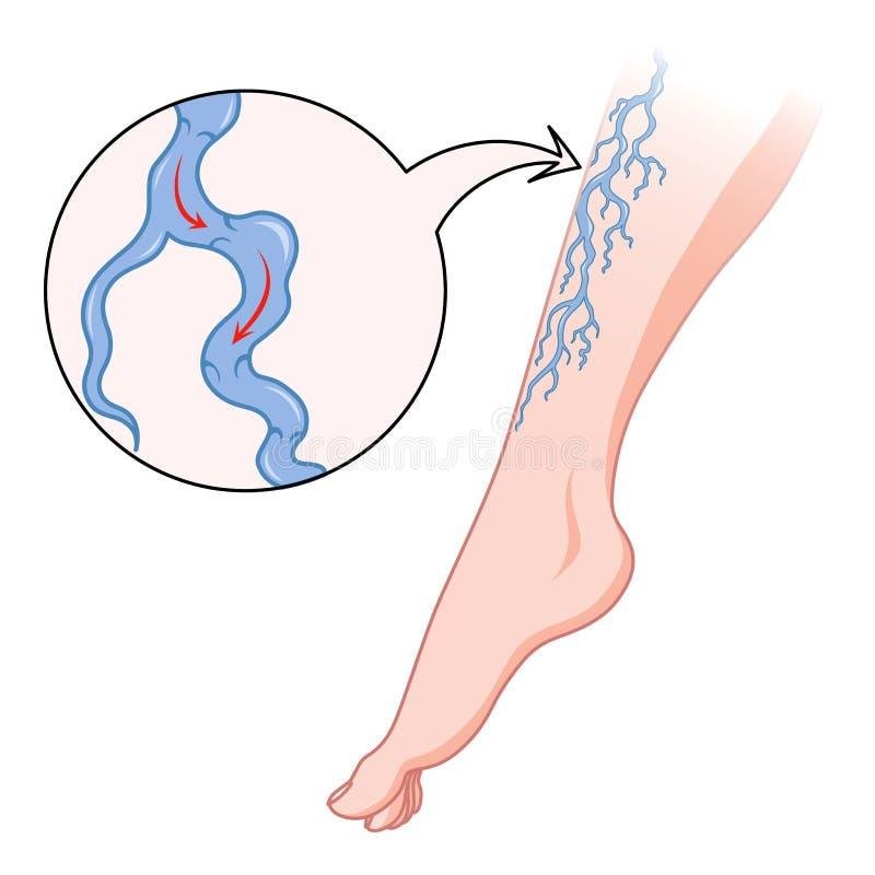 Varicose veins of the lower extremities drawing