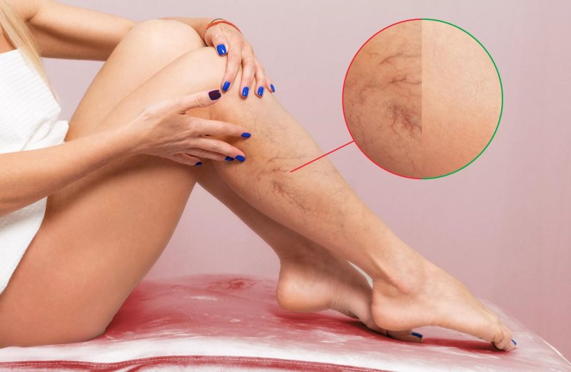 Varicosis of the legs