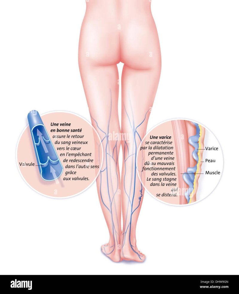 Venous hyperemia of varicose veins