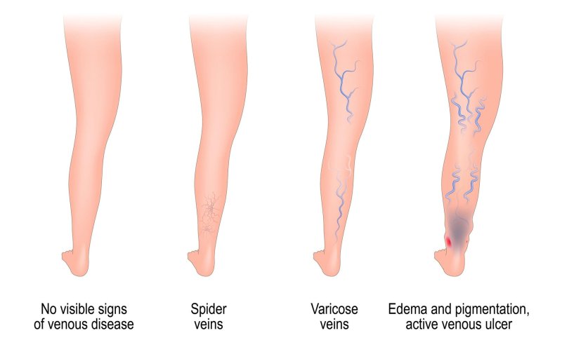 Varicose veins of the