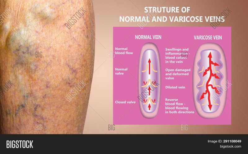 Varicose veins comparison
