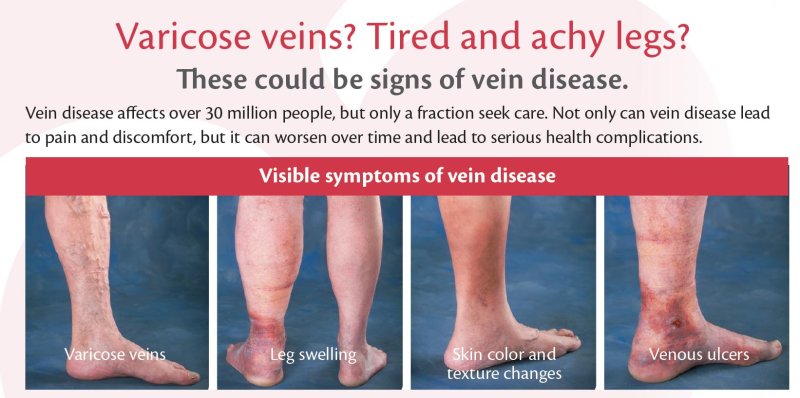 How to prevent varicose veins