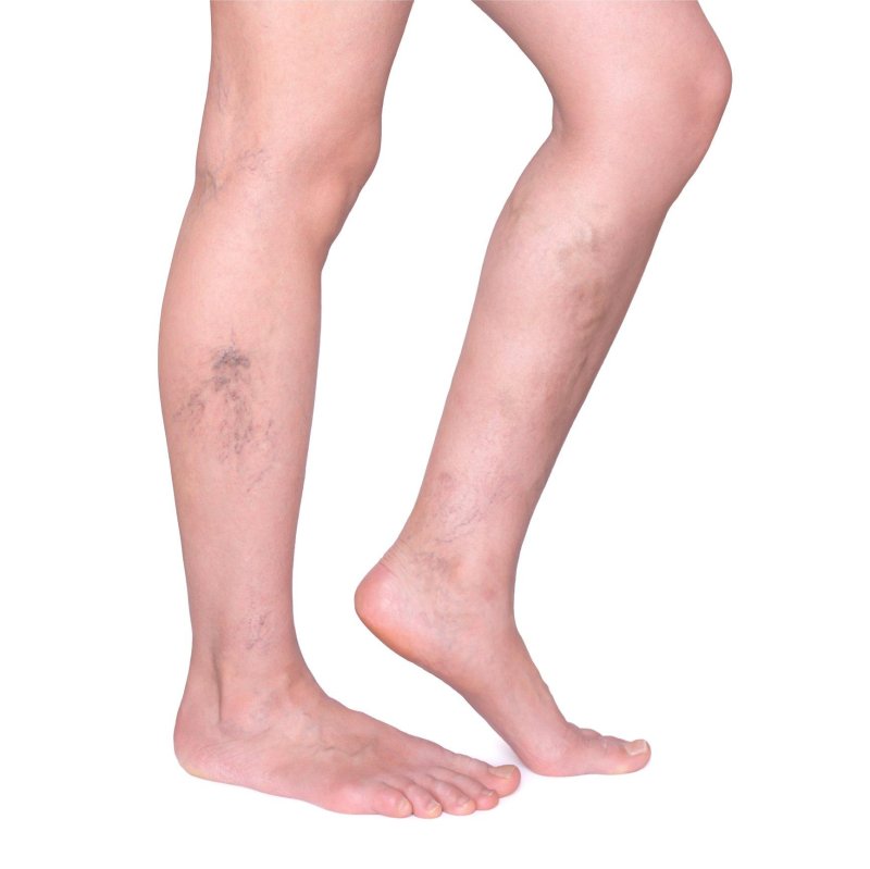 Trophilic ulcers varicose veins
