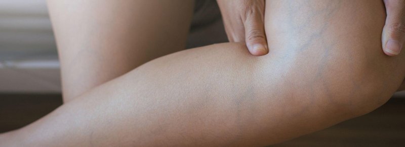 Varicose legs