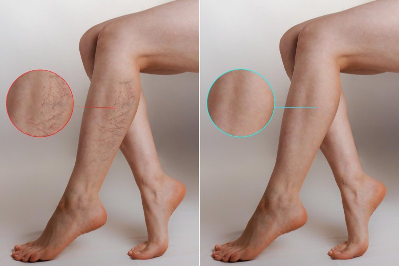 The causes of varicose veins