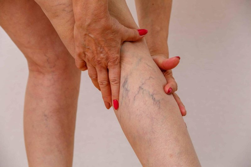 Cellulite veins on the legs