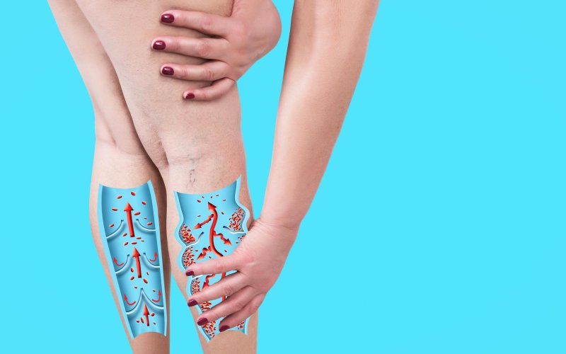 Varicose veins of the lower extremities