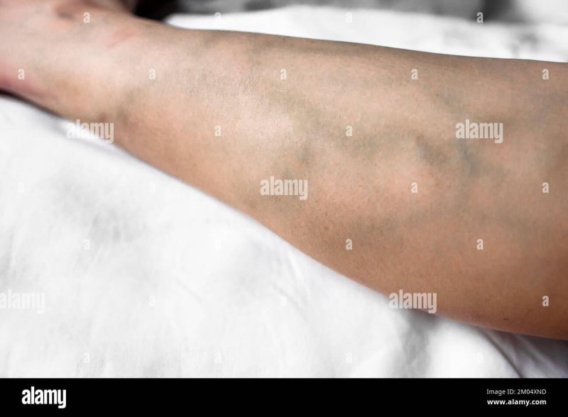 Post -imperative phlebitis