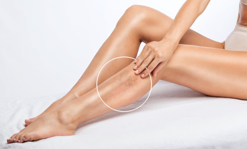 Varicose veins in women
