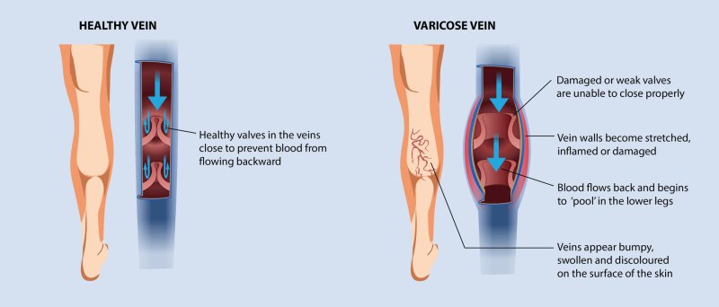 Varicose veins scheme