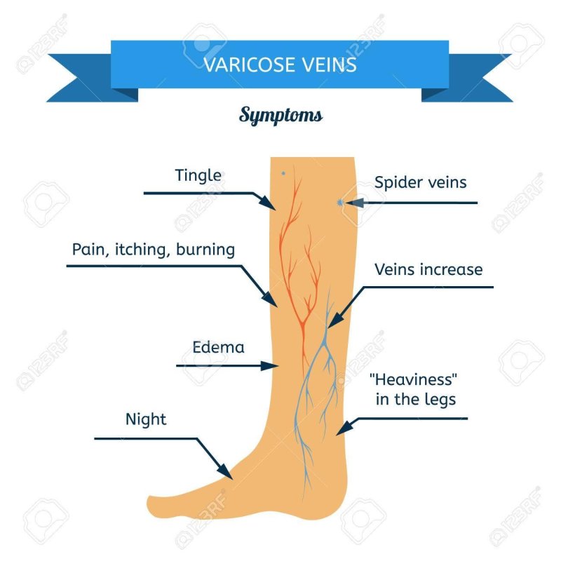 Varicose veins in leg