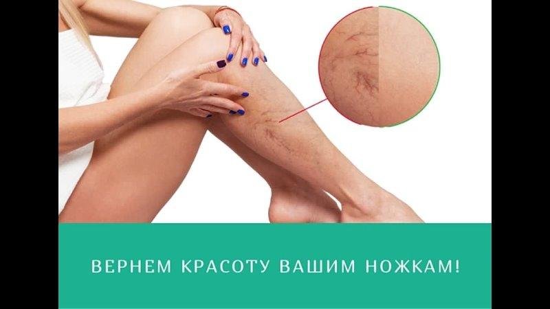 Varicose veins