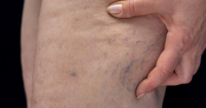 Varicose vein