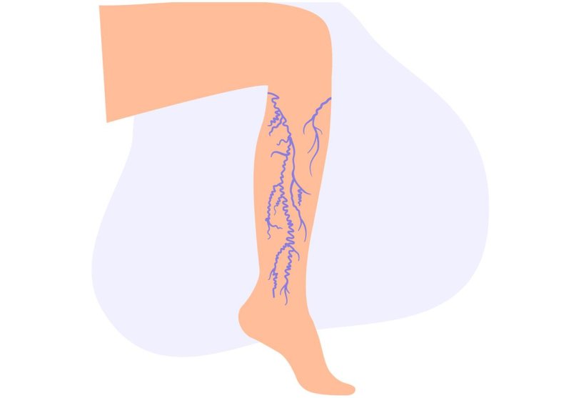 - vascular leg position
