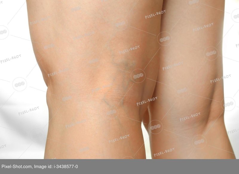 Close veins on the legs