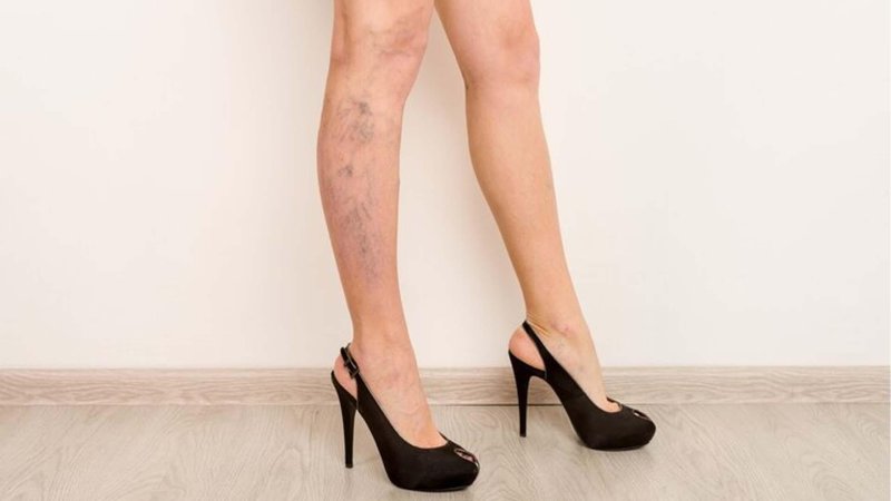 Varicose veins on the legs