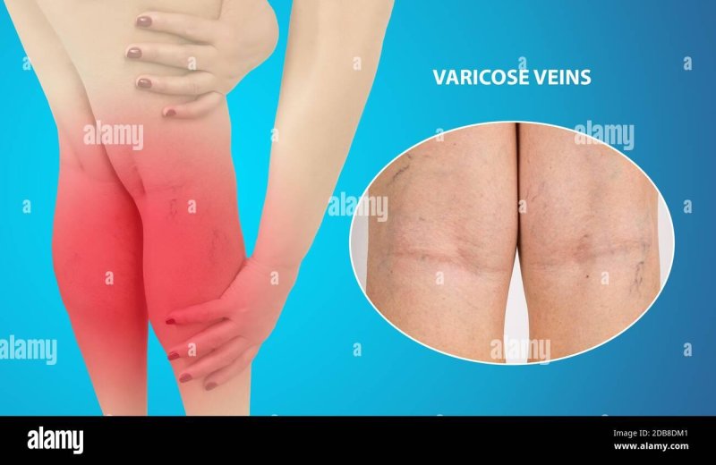 Deep vein thrombosis