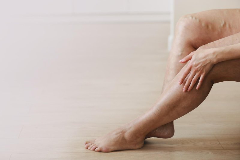Legs without varicose veins