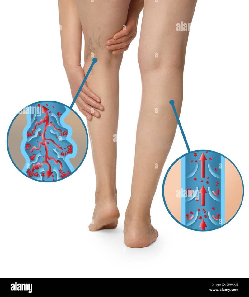 Phlebitis thrombophlebitis of the lower