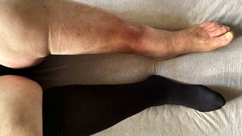 Posttrombophlebitical disease of the lower extremities