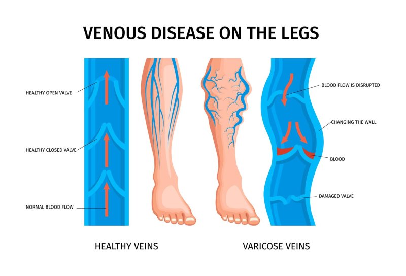 Vienna in the legs