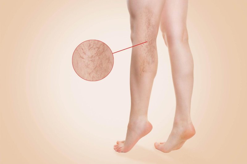 Varicose grid on the legs