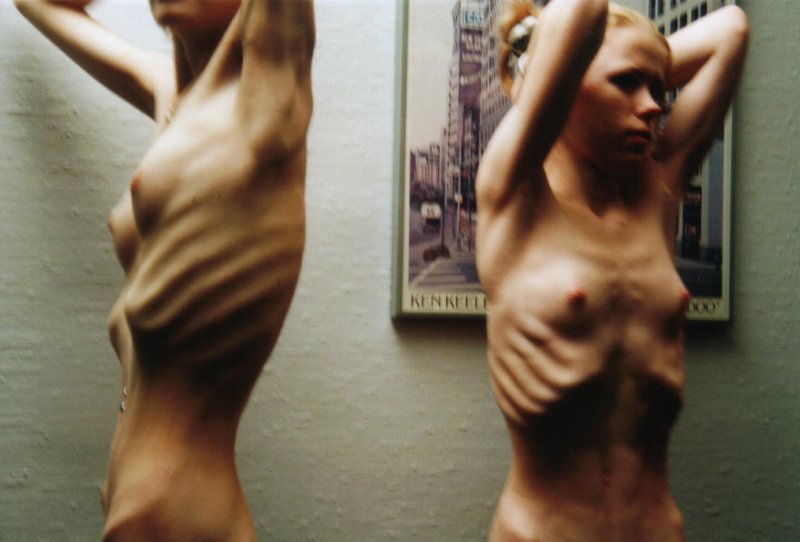 Nudes of anorexics